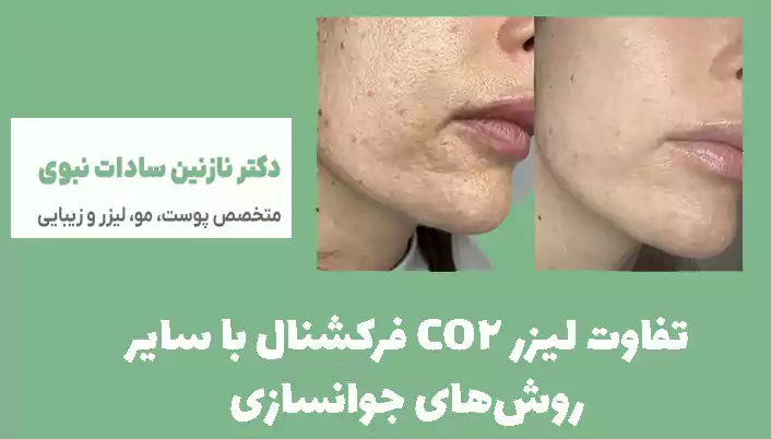 تفاوت لیزر CO2 فرکشنال با سایر روش‌های جوانسازی