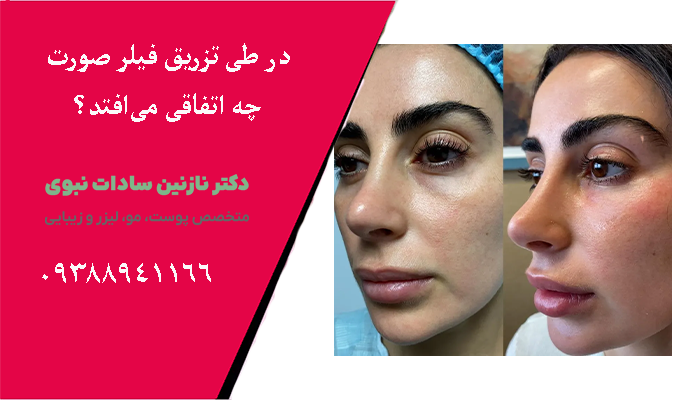 در طی تزریق فیلر صورت چه اتفاقی می‌افتد؟