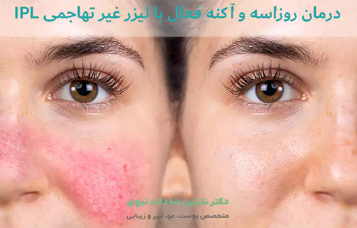 درمان روزاسه و آکنه فعال با لیزر غیر تهاجمی IPL