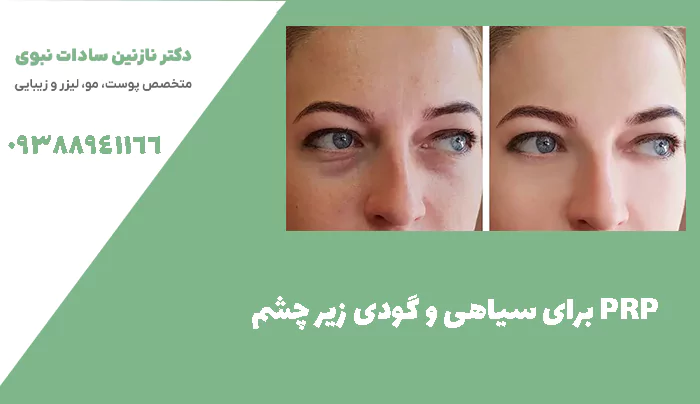 PRP برای سیاهی و گودی زیر چشم