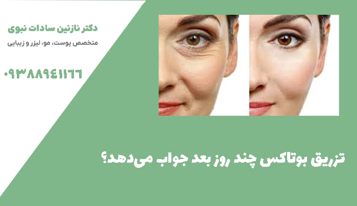 تزریق بوتاکس چند روز بعد جواب می‌دهد؟