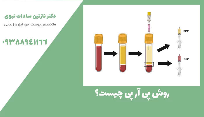 روش پی آر پی چیست؟