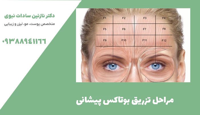 مراحل تزریق بوتاکس پیشانی