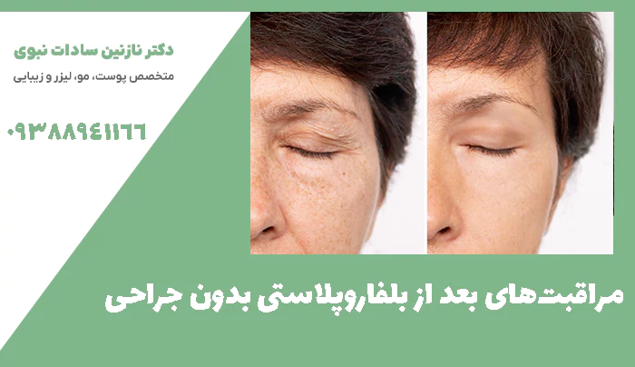 مراقبت‌های بعد از بلفاروپلاستی بدون جراحی