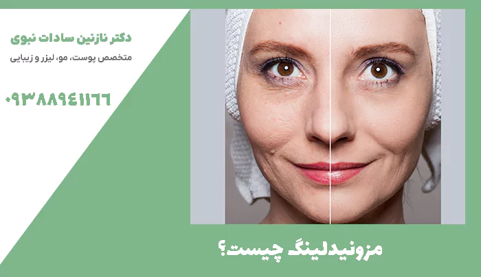 مزونیدلینگ چیست؟