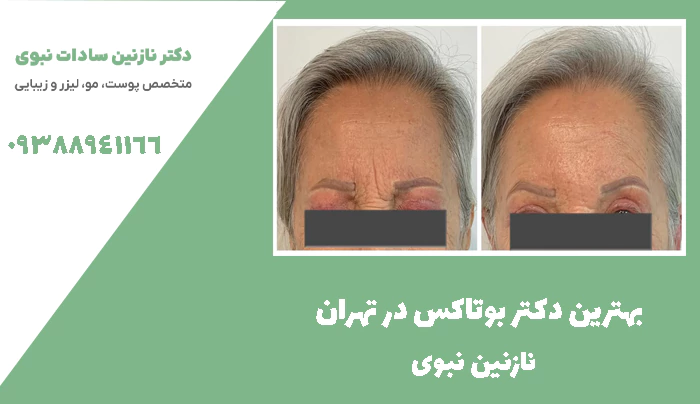 بهترین دکتر تزریق بوتاکس در تهران