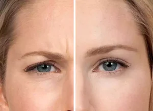 بوتاکس پنجه کلاغی