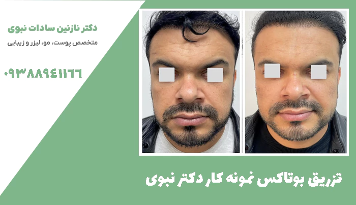 تزریق بوتاکس نمونه کار دکتر نبوی
