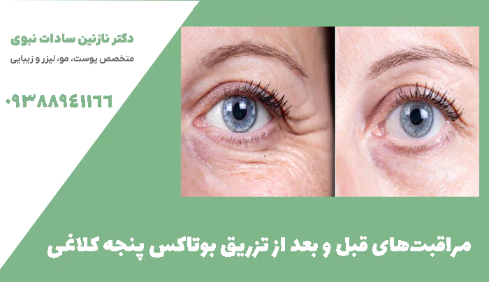 مراقبت‌های قبل و بعد از تزریق بوتاکس پنجه کلاغی