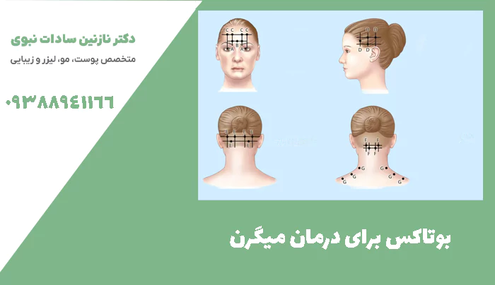 بوتاکس برای درمان میگرن