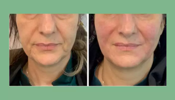 تزریق فیلر برای خط خنده نمونه کار تزریق فیز