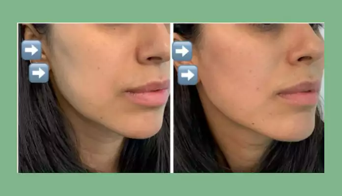 نمونه کار تزریق فیلر اصلاح فرم صورت