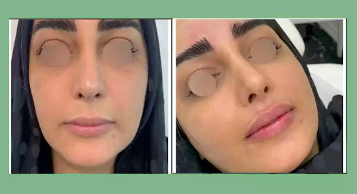 نمونه کار تزریق فیلر دکتر نازانین نبوی