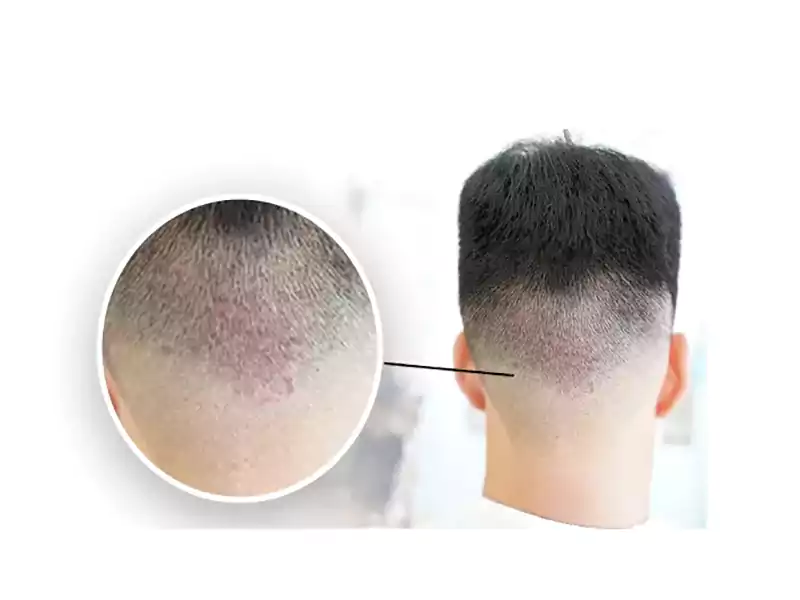 عوارض مزوتراپی موی سر