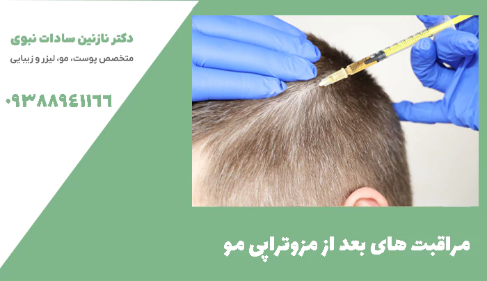 مراقبت های بعد از مزوتراپی مو